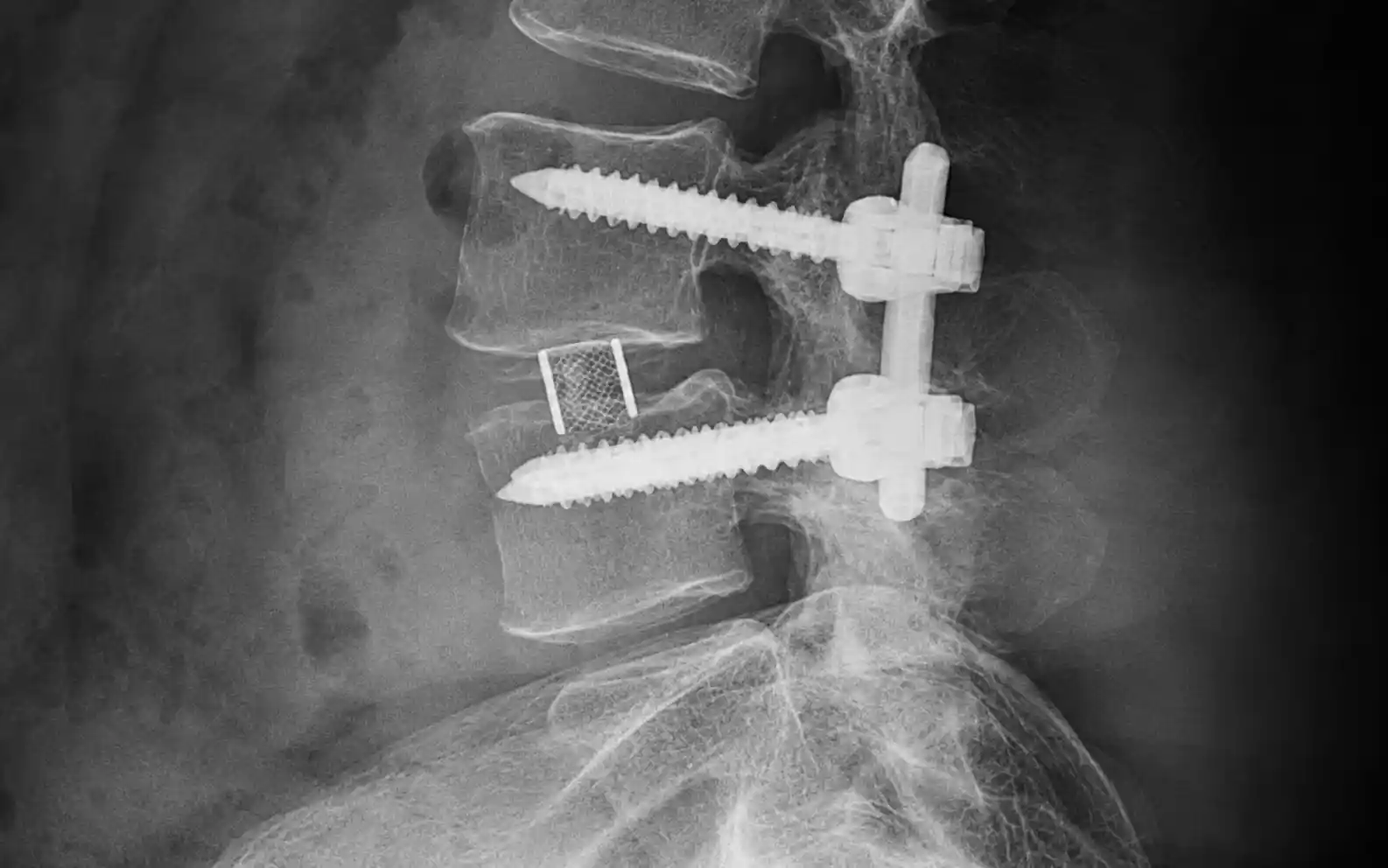 Spondylolisthesis spine fusion illustration