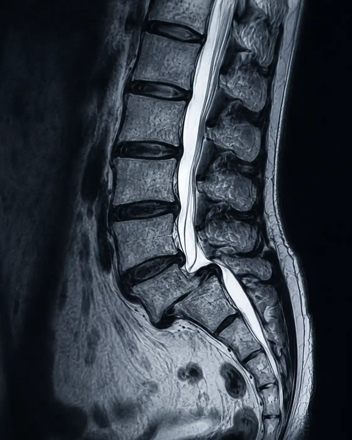 X-ray and MRI review for spondylolisthesis diagnosis