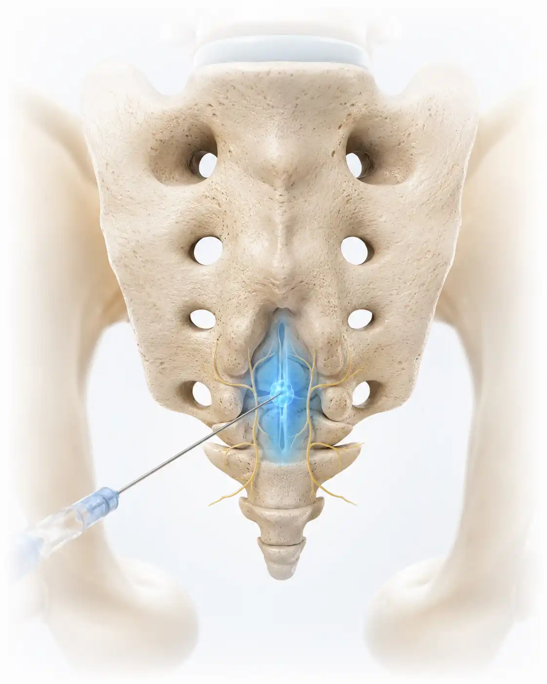 Illustration of the ganglion impar in front of the sacrococcygeal junction and the needle approach for the block