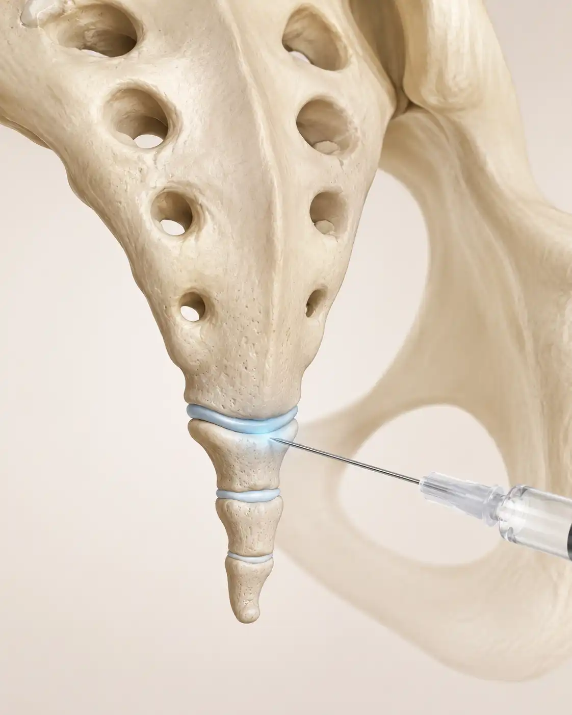 Illustration of a coccygeal tail bone injection placed at the sacrococcygeal joint under image guidance