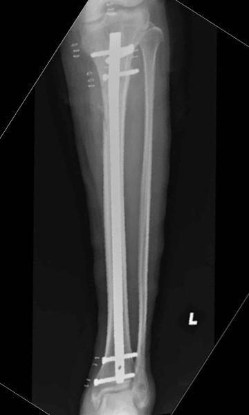 nail-xray-scaled